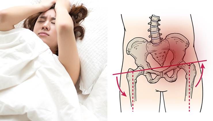 심한 생리통, 골반 틀어졌다는 신호일수도?