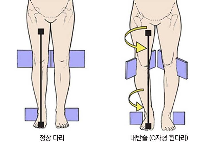 무릎살은 왜 찌는 걸까?