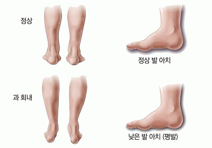 무릎살은 왜 찌는 걸까?