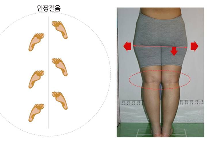 무릎살은 왜 찌는 걸까?