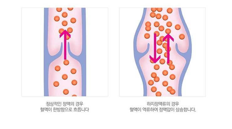 다이어터들의 적, 붓기에 대해 알아보자! -2-